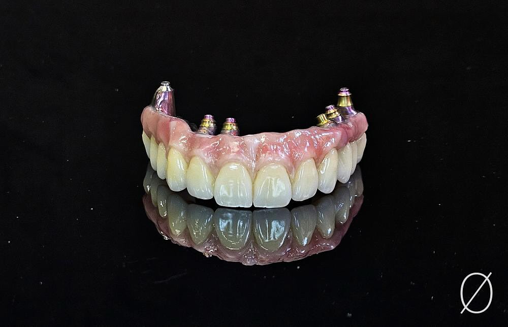 Prothèse dentaire complète supra-implantaire réalisée par LE LABO